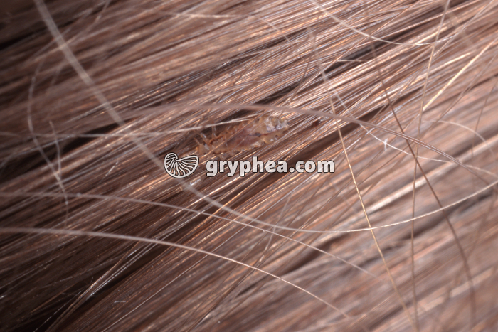 Pou dans les cheveux (Pediculus humanus capitis)  - gryphea.com